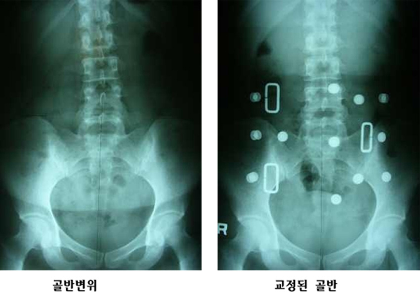 골반 1