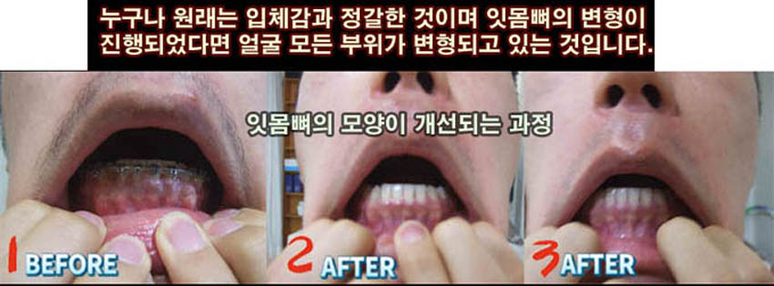 턱관절-13