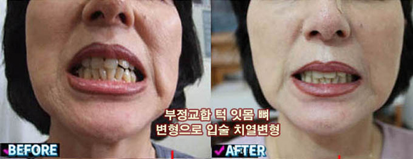 턱관절-14
