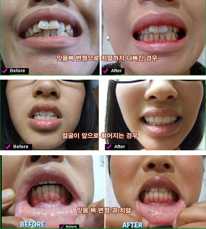 턱관절 02