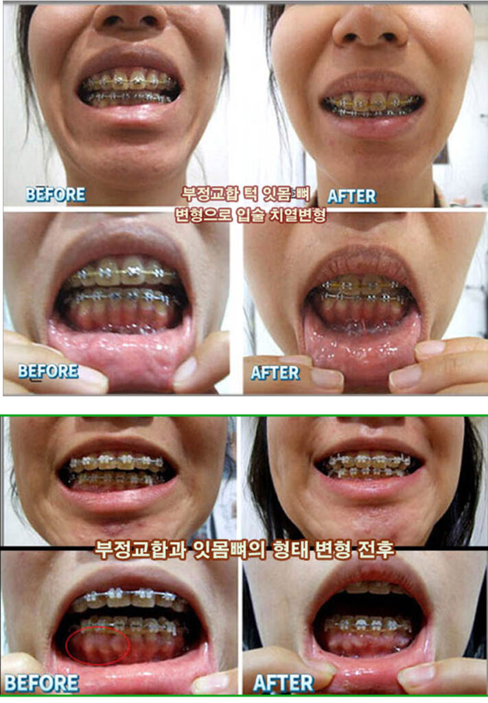 턱관절 03