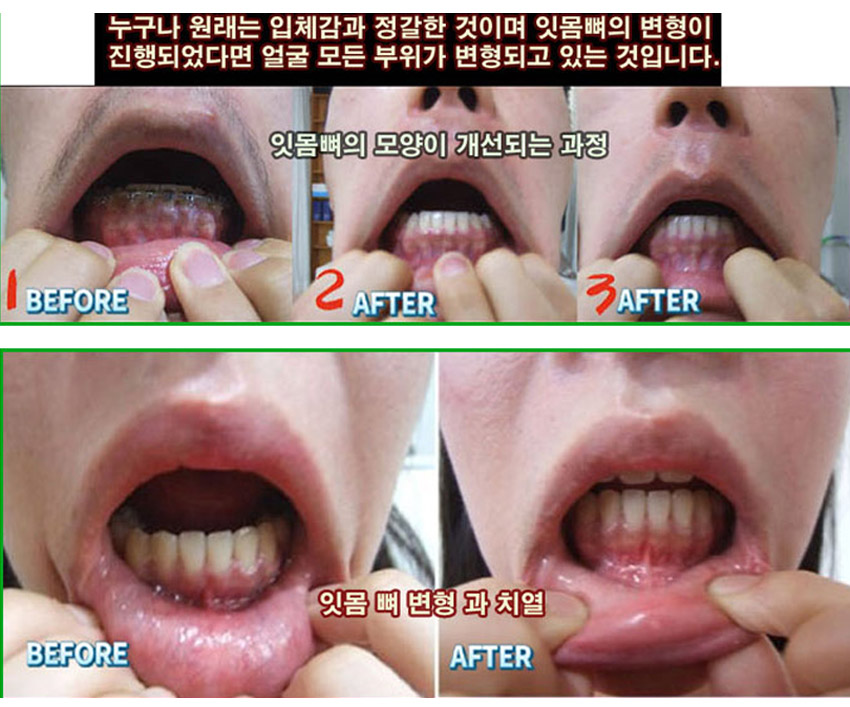 턱관절 05