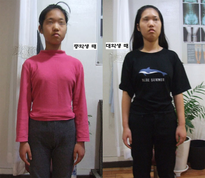 얼굴변형 성장기에 더욱 진행할수 있으며. 얼마나 변형이 진행이 되었냐에 인물 인상 나이가 결정이 되는 것이다. 
