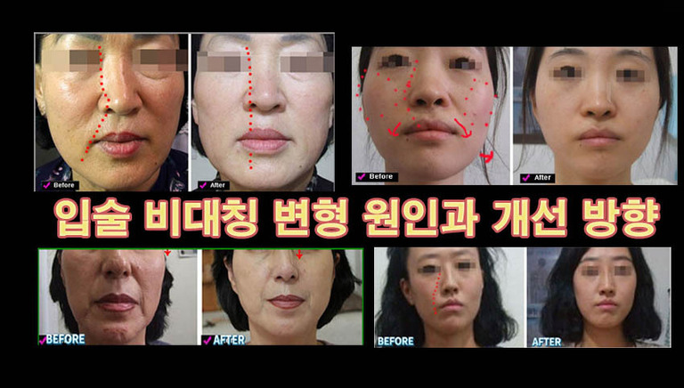 입술이 비대칭  안면비대칭 변형 걱정하지 마세요.