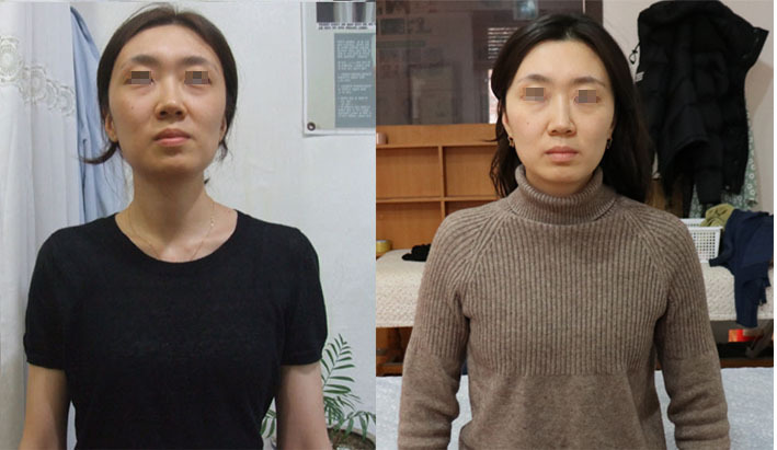 눈 꺼짐 볼꺼짐 얼굴처짐 얼굴길어짐 울퉁불퉁함 동안 등