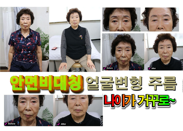 안면비대칭 눈주위꺼짐 얼굴꺼짐 팔자주름 주름 신체 노화 개선과정