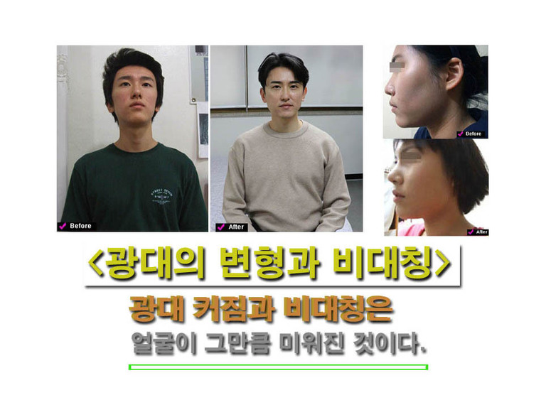 광대비대칭 변형 광대축소