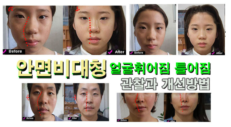 안면비대칭 얼굴틀어짐 휘어짐 대진당