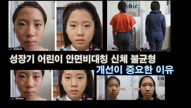 성장기 어린이 안면 비대칭과   신체 불균형이 관찰된다면  반드시 개선이 필요한 것입니다.