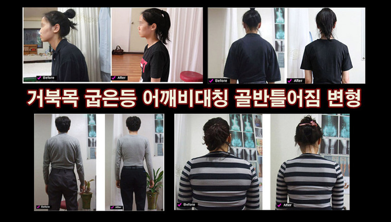 거북목거북목 굽은등 어깨 비대칭 골반 틀어짐 변형 안면비대칭