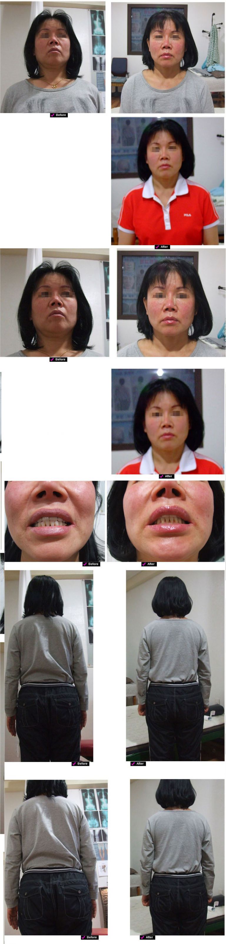 노화진행 안면비대칭 얼굴변형 얼굴처짐 등 