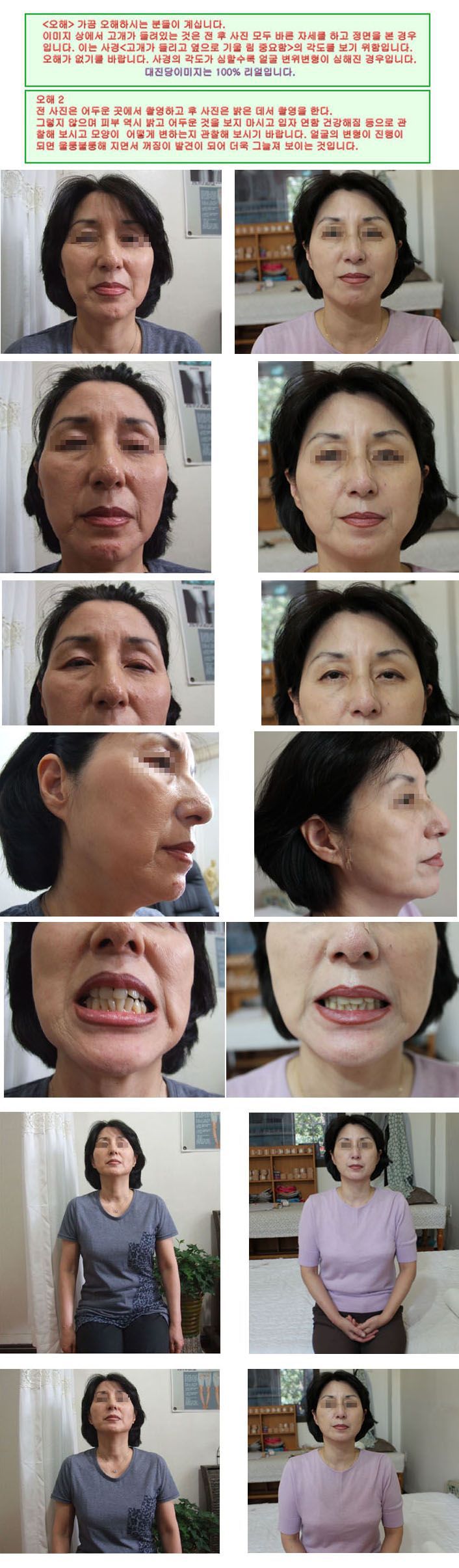 노화  얼굴 턱 부정교합 신체균형 이마 두상 옆광대 볼꺼짐 눈 등
