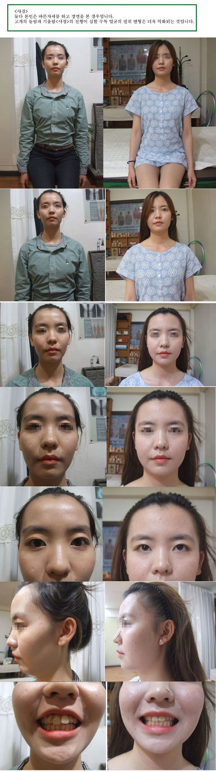 얼굴변위 변형 턱 부정교합 이마 눈 두상 옆광대 볼꺼짐 눈 신체불균형 등