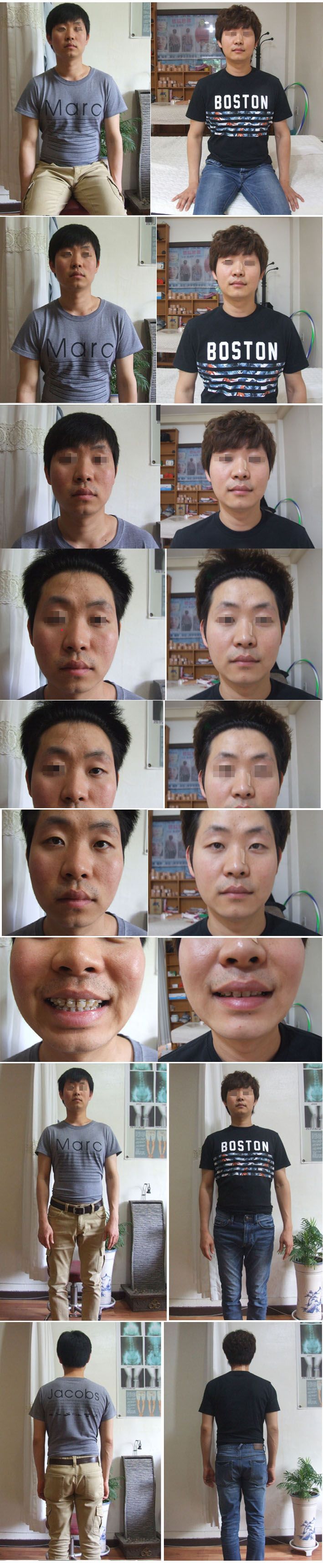 얼굴변위 변형 피부 신체균형 비율 이마 두상 광대 볼꺼짐 넓어짐 눈 등
