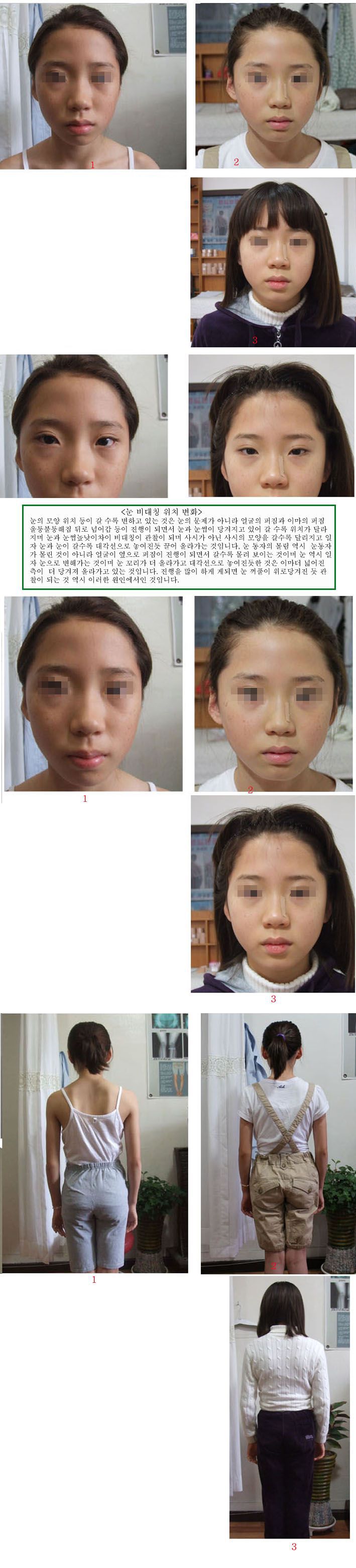 아동 얼굴변형 안면비대칭 신체변형  눈 변형 눈주위 꺼짐 등 