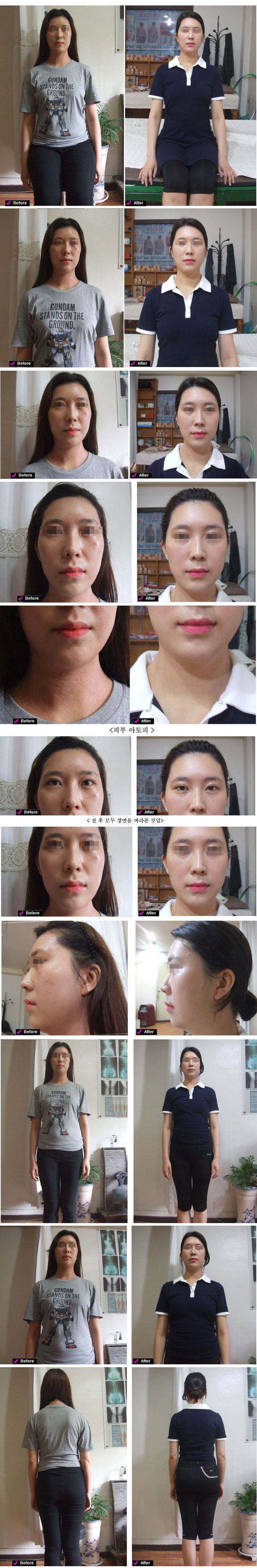 얼굴변위 변형 피부 신체균형 비율 이마 두상 광대 볼꺼짐 넓어짐 눈 등