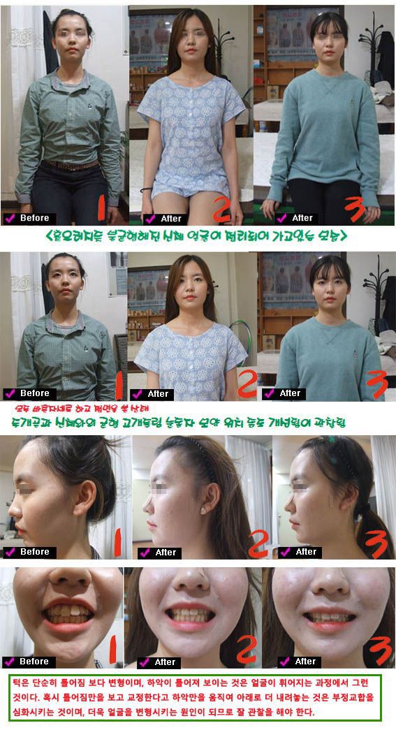 동안 신체균형 안면비대칭 턱관절장애 부정교합 얼굴변형 볼꺼짐 볼처짐 변형  4번째 이미지 추과
