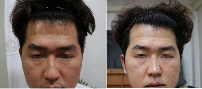 <15회 전 후 >이마꺼짐 다이어트 얼굴길어짐 인디언 주름 팔자주름 등 대진당 기치료원 