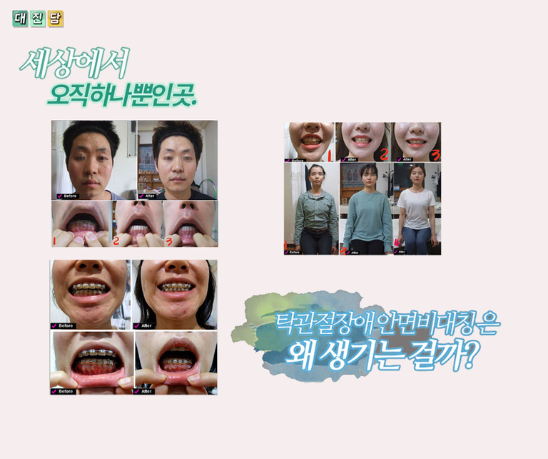 안면비대칭과 턱관절장애 턱비대칭은 왜 생길까요? 개선이 안 되는 이유~ 턱관절장애, 안면비대칭이 관찰이 된다면, 동안관리 예뻐지고 싶다면 꼭~ 보세요. 다른 이론,  신기한 효과 