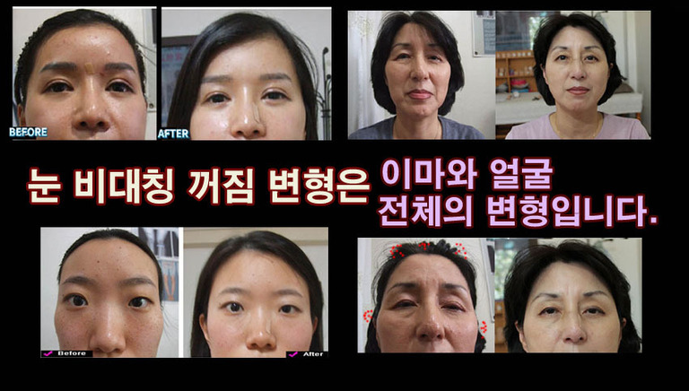 눈의 변형이 되고 있다면   얼굴이 그만큼 미워지고 있는 것입니다.