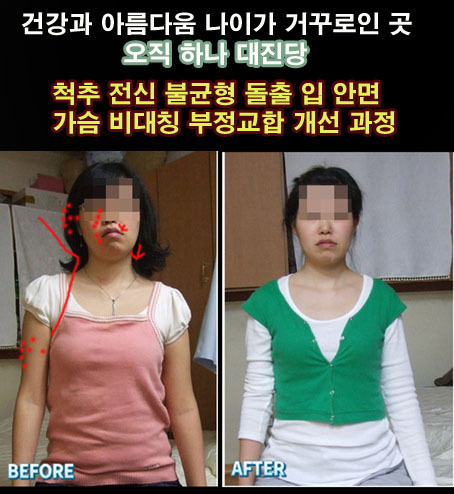 척추 전신불균형 안면비대칭