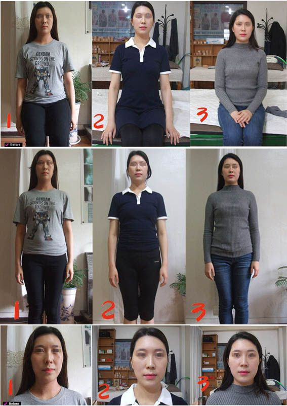 동안 얼굴처짐 길어짐 안면비대칭 신체 불균형 등 2 