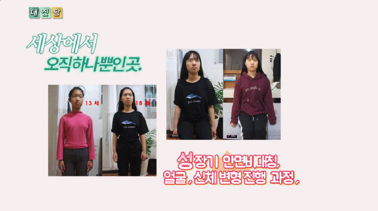 어린이 성장기 신체변형과 안면비대칭 진행과정과 15 회 전후 
