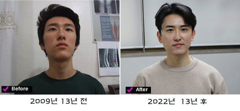 <13년 전 후 >< 누구나 나이를 먹는다. 나이가 들어갈수록 건강과 얼굴 신체의 모습은누구나 변해가는 것이다. 그 나이를 누가 뒤로 돌려 주겠는가? 대진당 기클리닉 대진당 