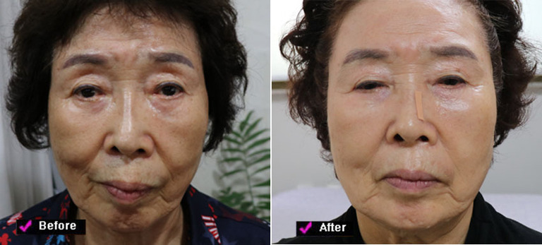 나이가 들어갈수록 얼굴의 변형이 심화할수록 눈 주위 꺼짐과 불 꺼짐 이마 등얼굴의 꺼져 보이는 부위가 심화하는 데 이는 꺼진 것이 아니라 얼굴의 커짐에 대진당 기클리닉 대진당 