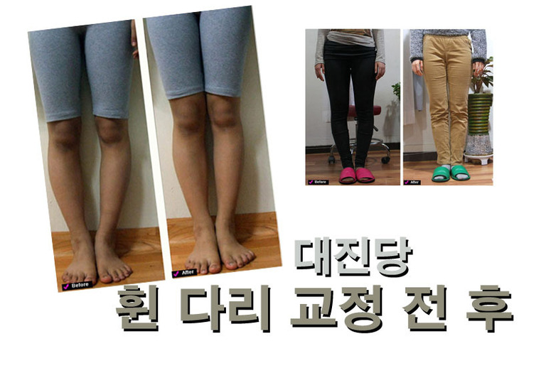 휜 다리개선 전후