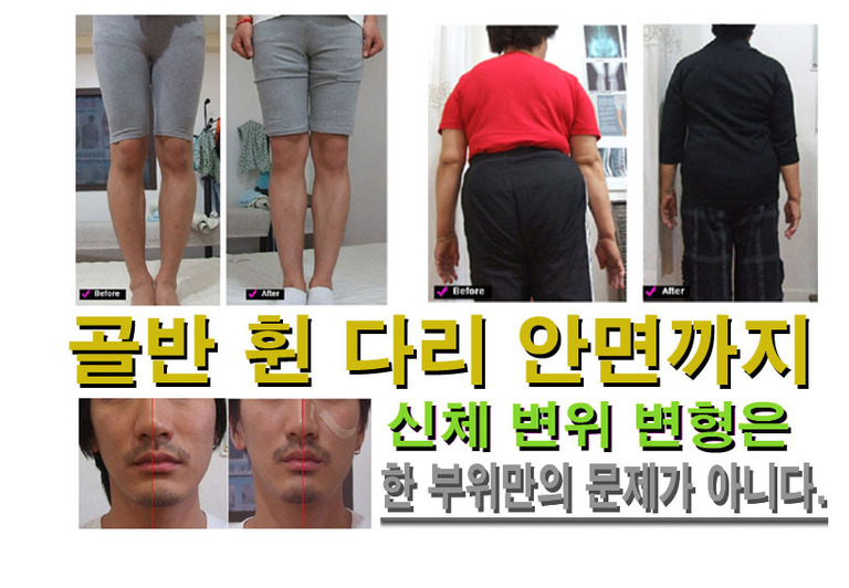 안면비대칭 골반, 휜다리, 신체불균형 전 후