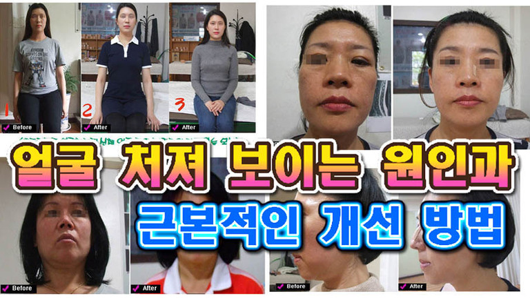 얼굴이 처져보이는 것은  단순히  근육, 피부만의 문제가 아닙니다.