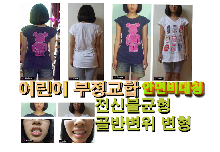어린이 골반 신체불균형 자세 휜다리 턱관절장애 부정교합 얼굴비대칭 전 후