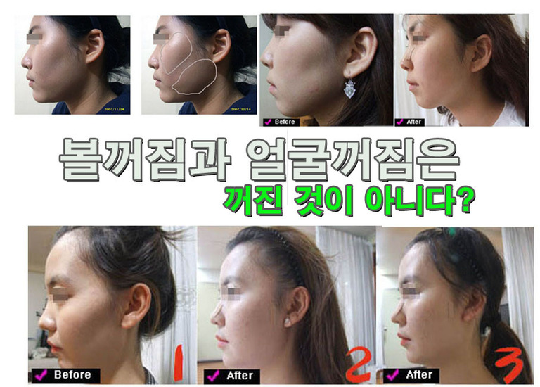 불꺼짐 눈꺼짐 관자놀이 꺼짐 등