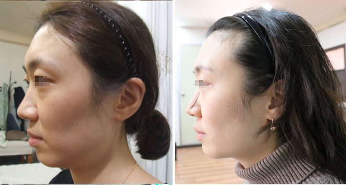 < 영상 > 볼꺼짐 얼굴꺼짐도 다시 보자.. 꺼진볼 눈꺼짐 눈주위꺼짐 안면비대칭교정 , 얼굴비대칭교정 