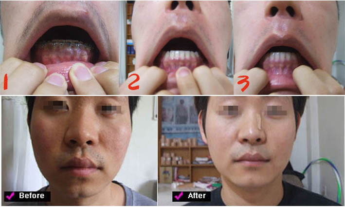 <영상>입술비대칭 턱관절장애 턱비대칭 입삐뚫어짐 안면비대칭교정 얼굴휘어짐은