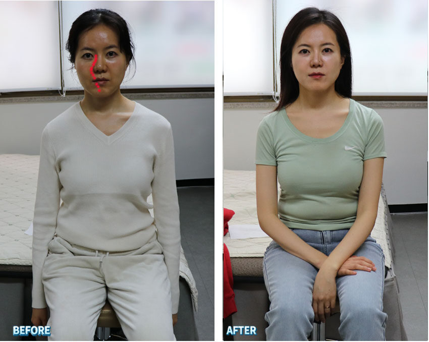 30화 전신 교정으로 달라진 모습 – 얼굴보다 몸의 변화가 더 눈에 띄는 이유