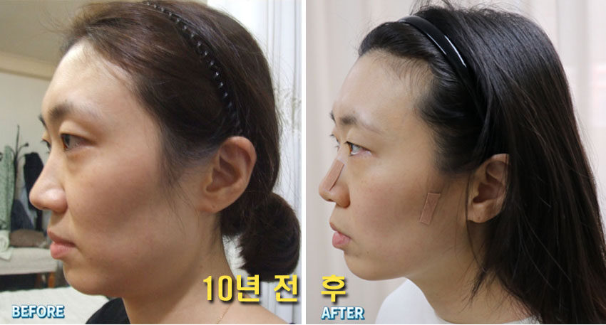 [안면비대칭] 볼꺼짐, 볼처짐, 눈주위·관자놀이 꺼짐 원인과 해결 (필러 전 필독!) 대진당 기클리닉