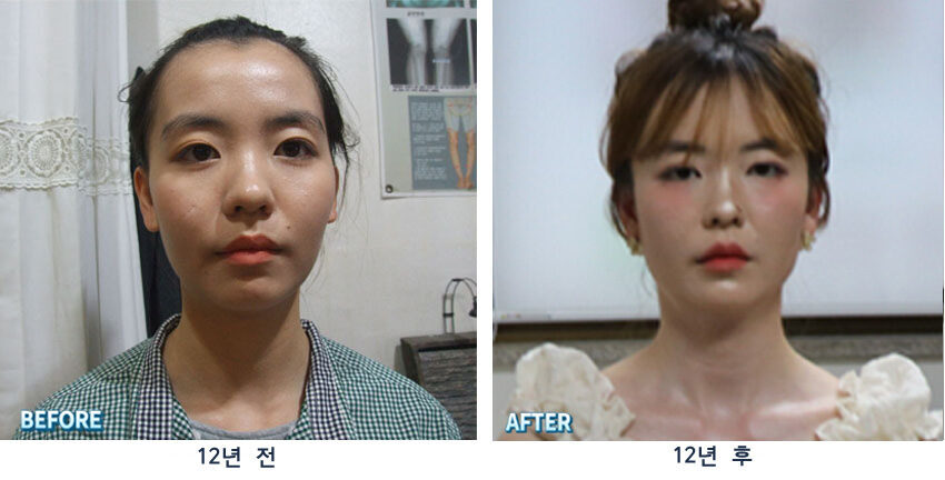 12년 전/후로 보는 동안관리 & 동안 안면비대칭교정 (대진당)