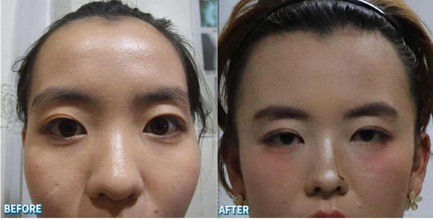 눈꺼짐·눈주위 꺼짐·눈비대칭 전/후 대진당 눈비대칭 교정