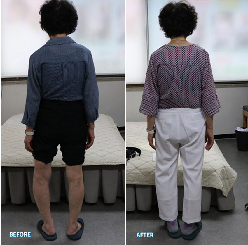 무릎통증 환자의 골반·다리 전신 불균형 교정 전후 비교 ( 대진당 기 클리닉 )