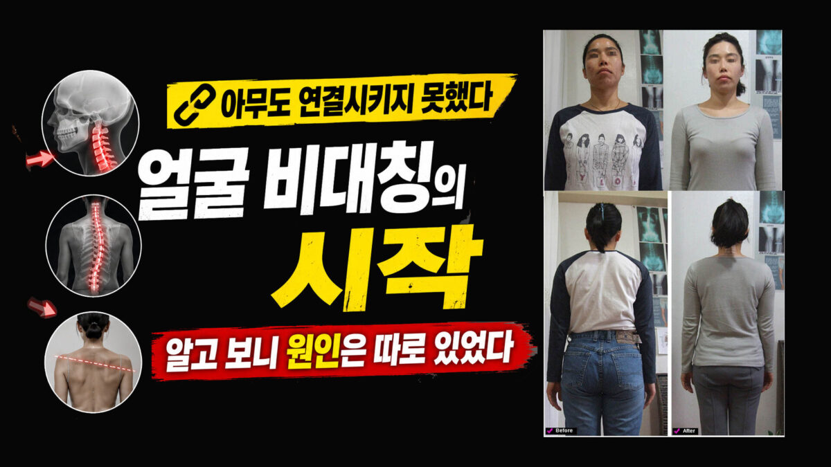 얼굴 비대칭, 단순히 턱 때문일까? 근본적인 원인과 해결법 (대진당) 15회  전 후 영상
