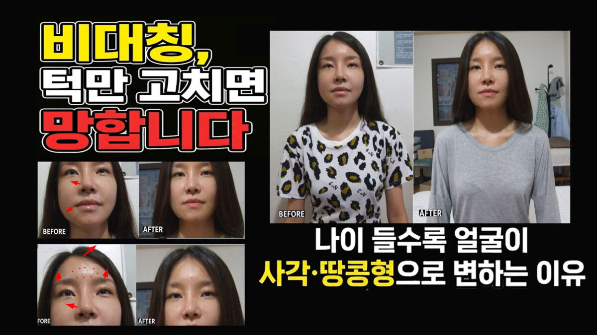 턱 비대칭 땅콩형 얼굴, 사각턱 고민? 얼굴 뼈 모양부터 바로잡아야 하는 이유 대진당 전후