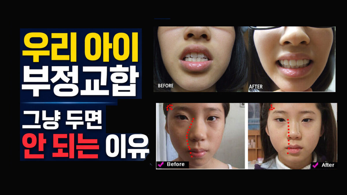 성장기 안면비대칭과 소아 턱교정, 턱만 보면 안 되는 이유 (눈·코·이마까지 변하는 원인)