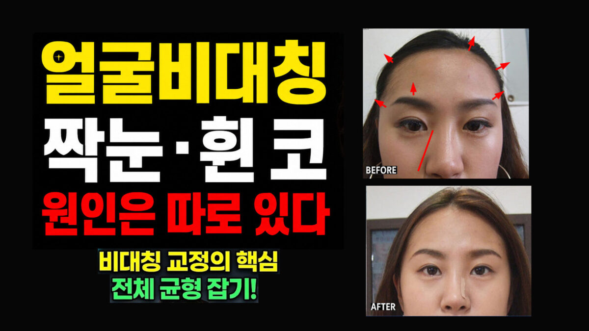 짝눈인 줄 알았는데… 이마·두상에서 시작되는 안면비대칭 교정법 및 원인 총정리