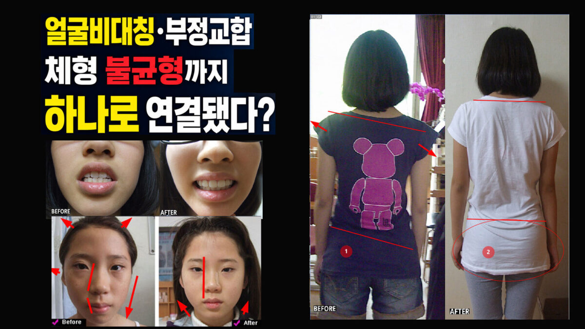 성장기 안면비대칭과 부정교합, 턱만 문제일까? 전신 자세 교정 골든타임 총정리  통합본